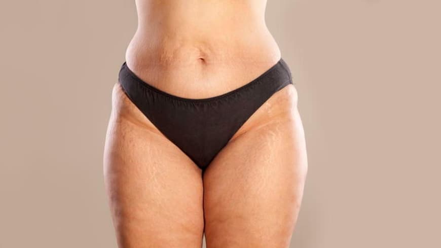 Eine Frau mit Lipödem an Bauch und Beinen