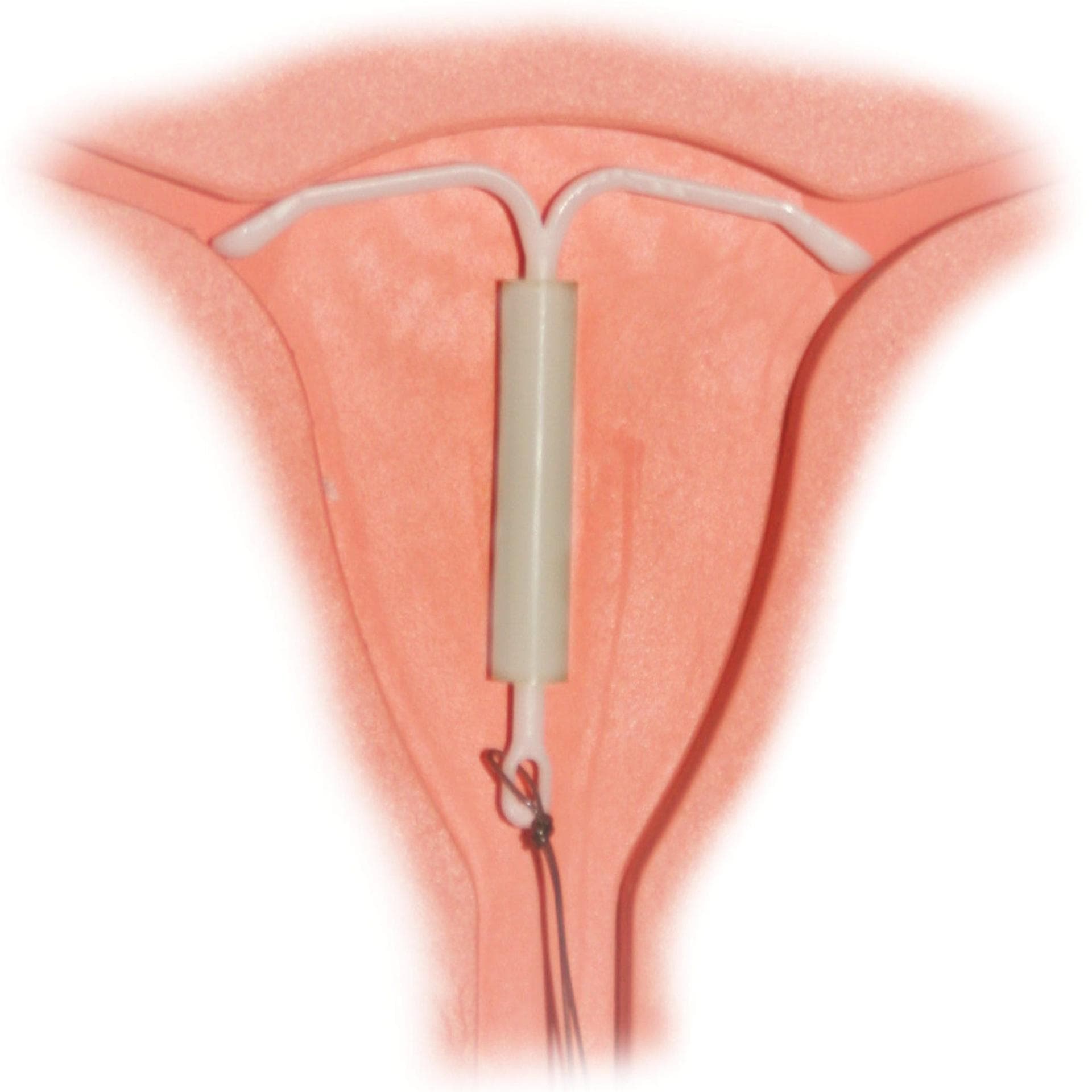 Mirena_IntraUterine_System