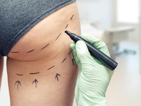Markierung zur Fettabsaugung am Po