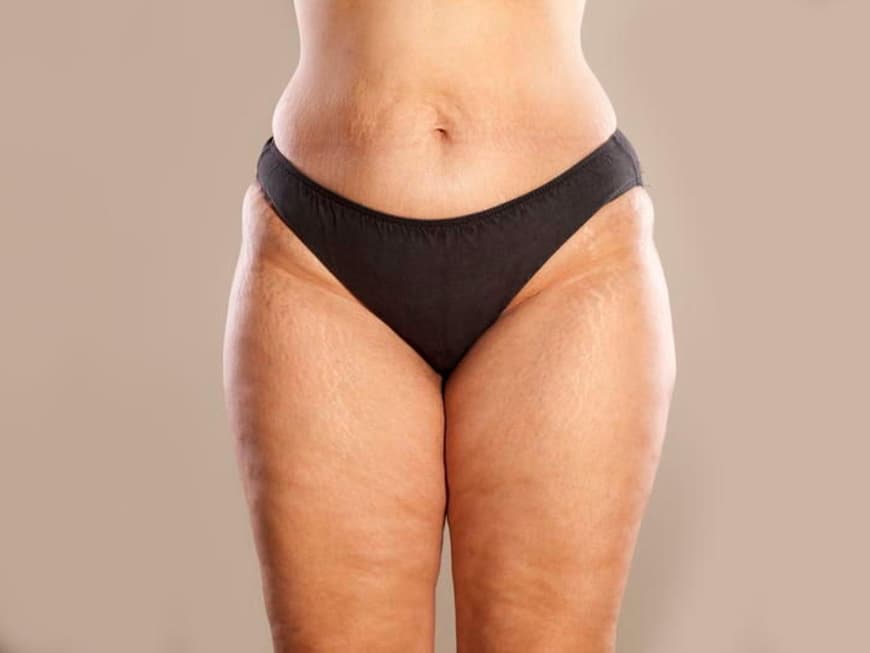 Eine Frau mit Lipödem an Bauch und Beinen